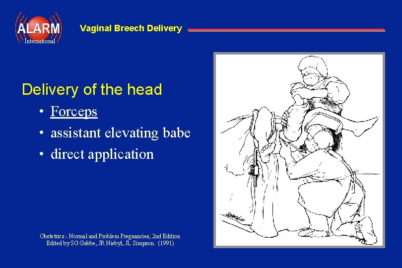 Vaginal Breech Delivery International Delivery of the head • Forceps • assistant elevating babe