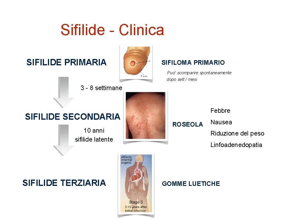Sifilide - Clinica SIFILIDE PRIMARIA SIFILOMA PRIMARIO Puo’ scomparire spontaneamente dopo sett / mesi