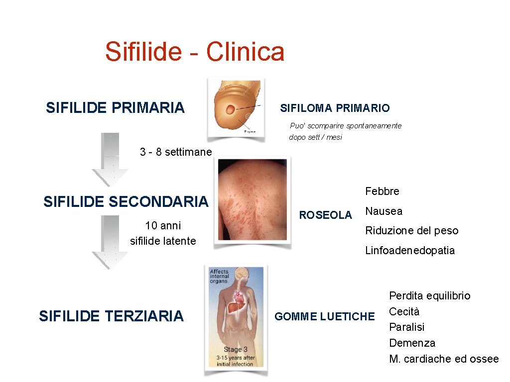 Sifilide - Clinica SIFILIDE PRIMARIA SIFILOMA PRIMARIO Puo’ scomparire spontaneamente dopo sett / mesi