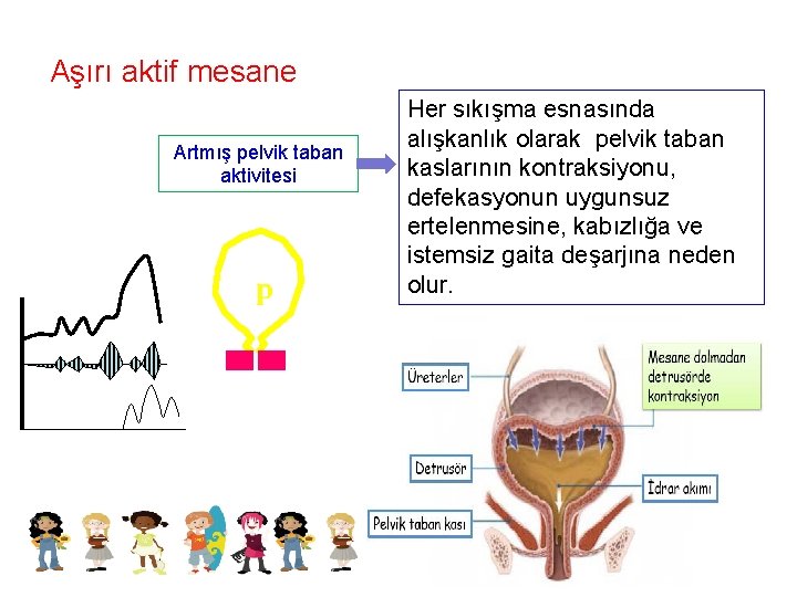 Aşırı aktif mesane Artmış pelvik taban aktivitesi p Her sıkışma esnasında alışkanlık olarak pelvik