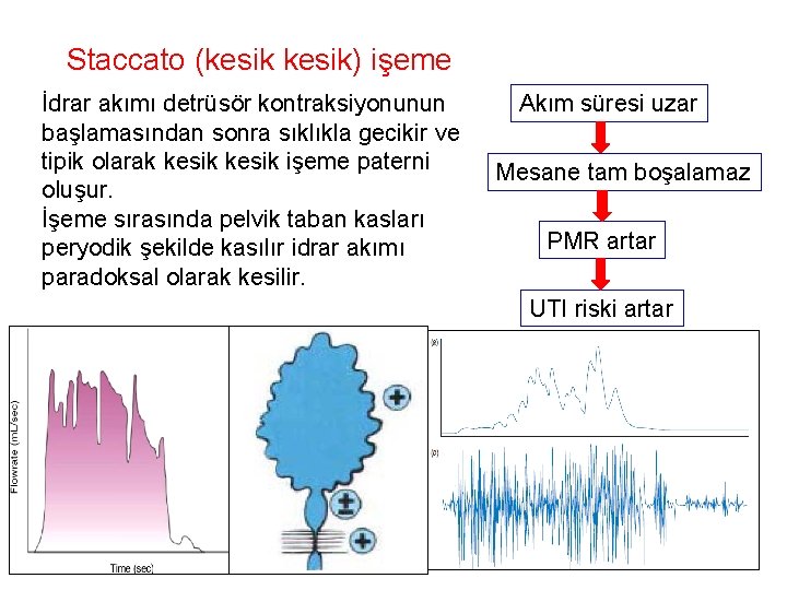 Staccato (kesik) işeme İdrar akımı detrüsör kontraksiyonunun başlamasından sonra sıklıkla gecikir ve tipik olarak