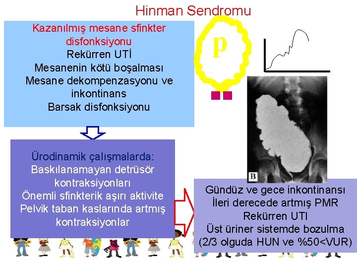 Hinman Sendromu Kazanılmış mesane sfinkter disfonksiyonu Rekürren UTİ Mesanenin kötü boşalması Mesane dekompenzasyonu ve