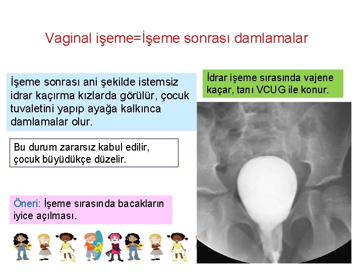 Vaginal işeme=İşeme sonrası damlamalar İşeme sonrası ani şekilde istemsiz idrar kaçırma kızlarda görülür, çocuk