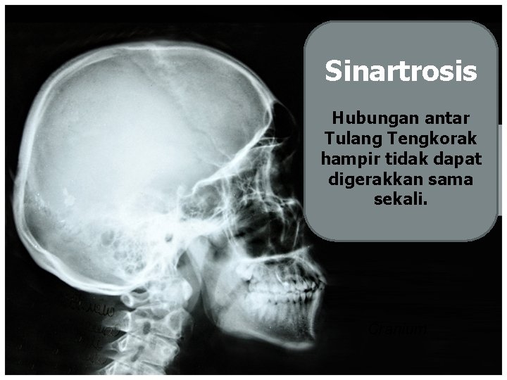 Sinartrosis Hubungan antar Tulang Tengkorak hampir tidak dapat hampir tidak digerakkan sama dapat digerakkan