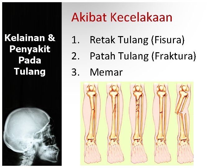 Akibat Kecelakaan Kelainan & Penyakit Pada Tulang 1. Retak Tulang (Fisura) 2. Patah Tulang