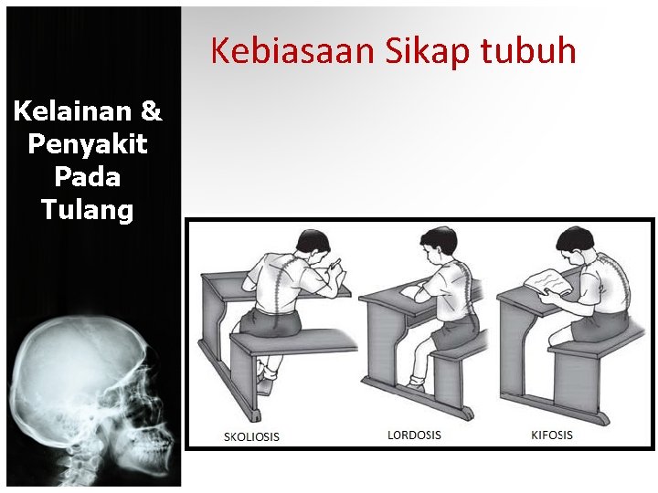 Kebiasaan Sikap tubuh Kelainan & Penyakit Pada Tulang 