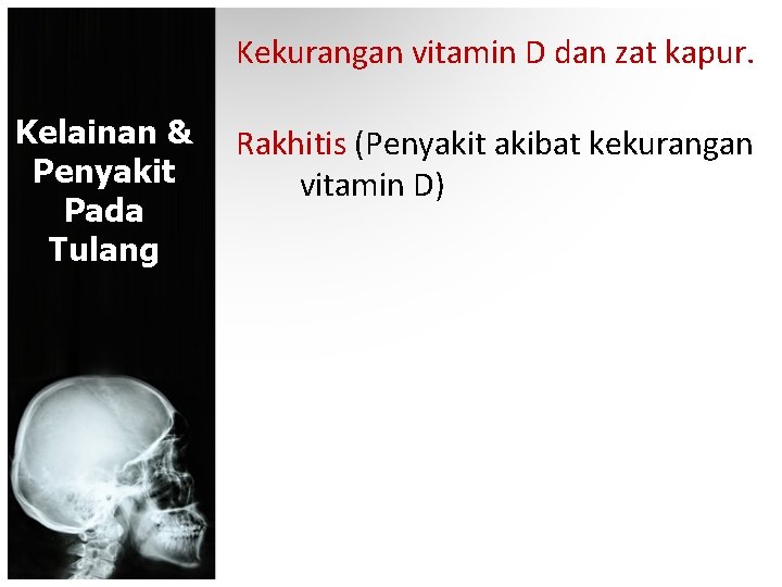 Kekurangan vitamin D dan zat kapur. Kelainan & Penyakit Pada Tulang Rakhitis (Penyakit akibat