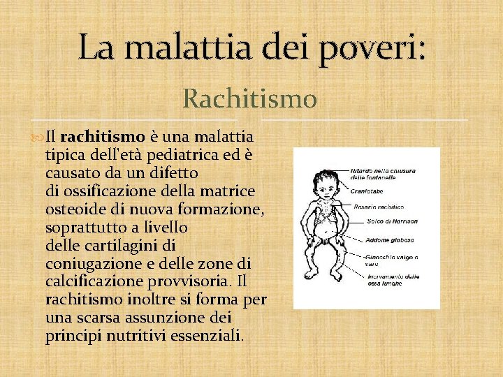 La malattia dei poveri: Rachitismo Il rachitismo è una malattia tipica dell'età pediatrica ed