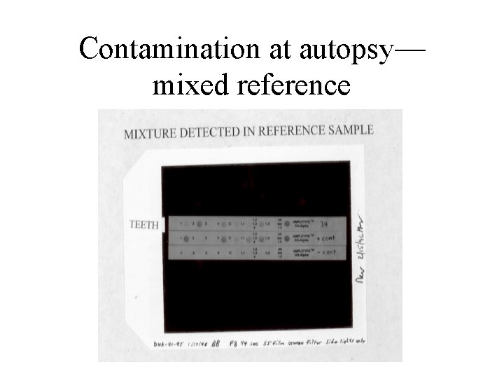 Contamination at autopsy— mixed reference 