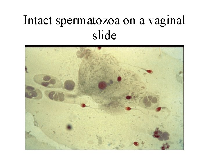 Intact spermatozoa on a vaginal slide 