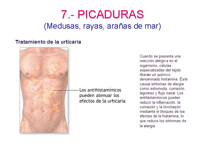 7. - PICADURAS (Medusas, rayas, arañas de mar) 