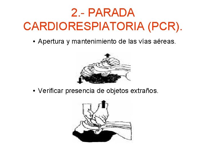 2. - PARADA CARDIORESPIATORIA (PCR). • Apertura y mantenimiento de las vías aéreas. •