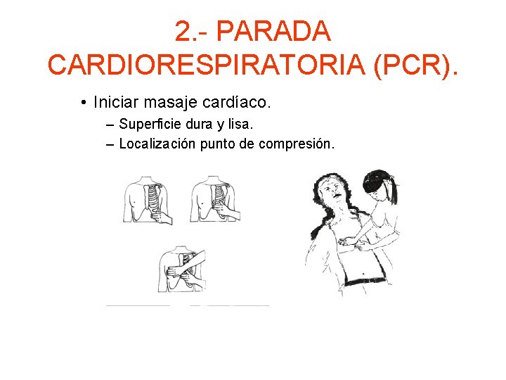 2. - PARADA CARDIORESPIRATORIA (PCR). • Iniciar masaje cardíaco. – Superficie dura y lisa.