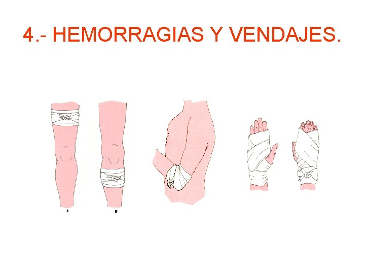 4. - HEMORRAGIAS Y VENDAJES. 