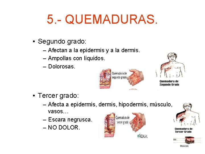 5. - QUEMADURAS. • Segundo grado: – Afectan a la epidermis y a la