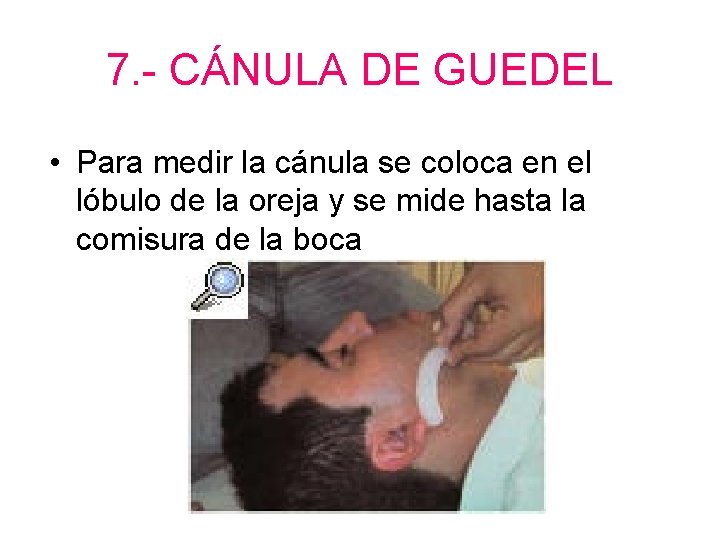 7. - CÁNULA DE GUEDEL • Para medir la cánula se coloca en el