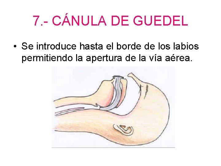 7. - CÁNULA DE GUEDEL • Se introduce hasta el borde de los labios