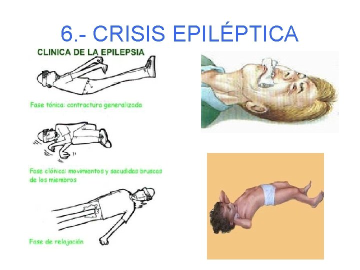 6. - CRISIS EPILÉPTICA 