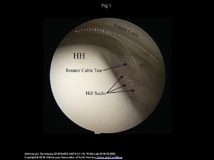 Fig 1 Arthroscopy Techniques 2019 8 e 623 -e 627 DOI: (10. 1016/j. eats.