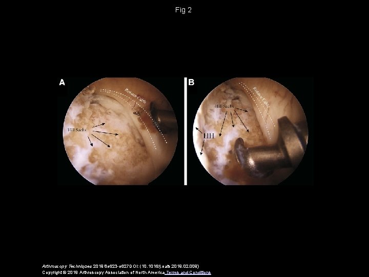 Fig 2 Arthroscopy Techniques 2019 8 e 623 -e 627 DOI: (10. 1016/j. eats.