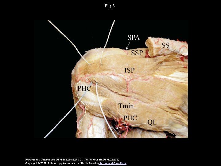 Fig 6 Arthroscopy Techniques 2019 8 e 623 -e 627 DOI: (10. 1016/j. eats.