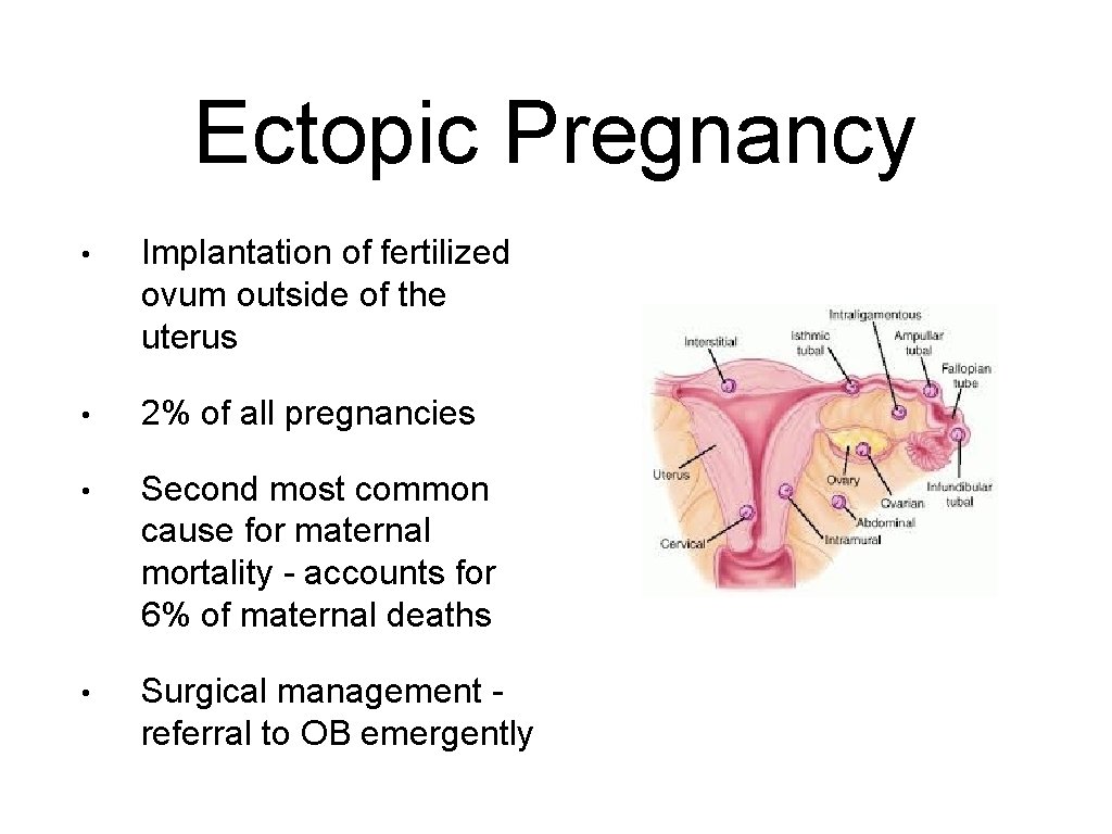 Ectopic Pregnancy • Implantation of fertilized ovum outside of the uterus • 2% of