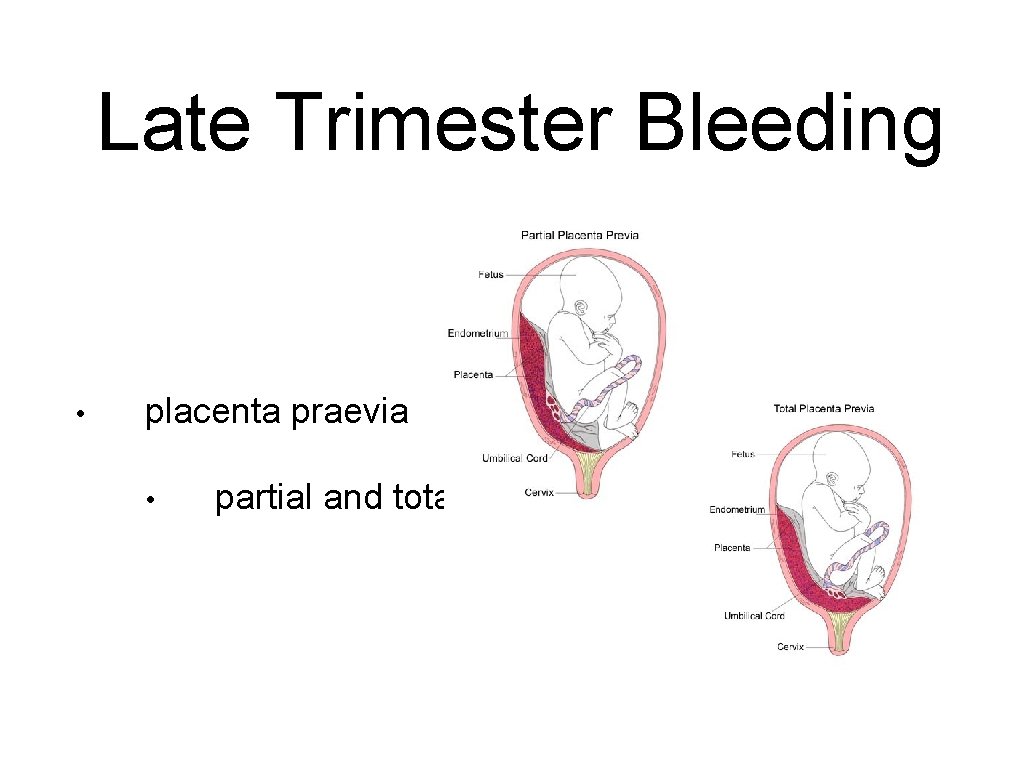 Late Trimester Bleeding • placenta praevia • partial and total 