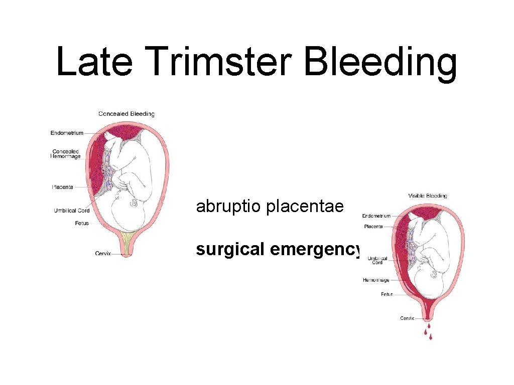 Late Trimster Bleeding • abruptio placentae • surgical emergency 