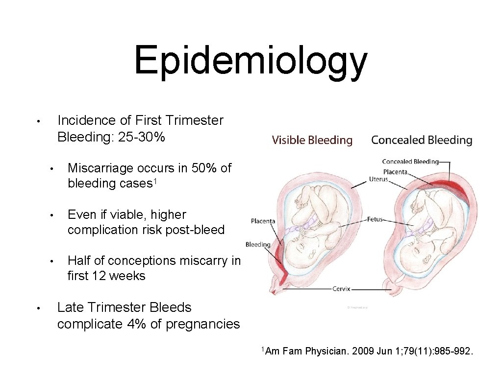 Epidemiology Incidence of First Trimester Bleeding: 25 -30% • • • Miscarriage occurs in