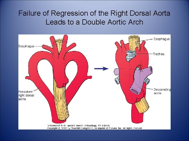 Failure of Regression of the Right Dorsal Aorta Leads to a Double Aortic Arch