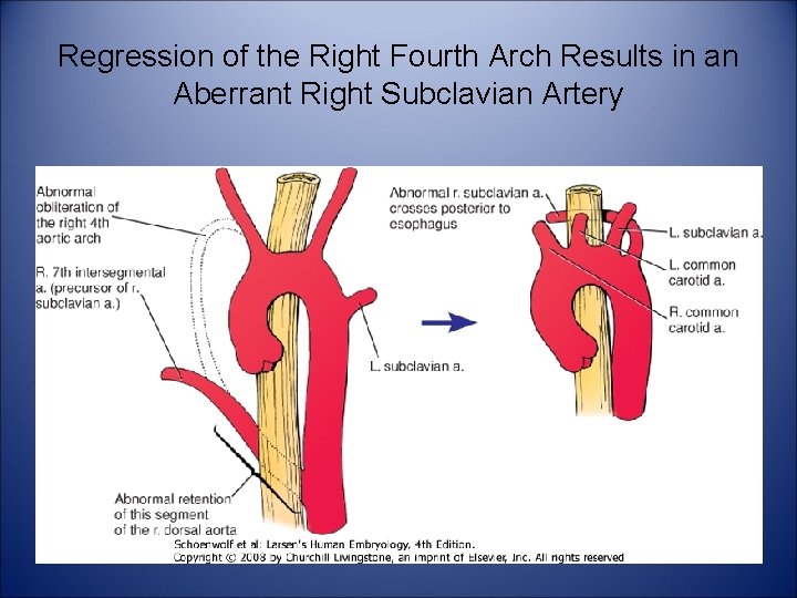 Regression of the Right Fourth Arch Results in an Aberrant Right Subclavian Artery 
