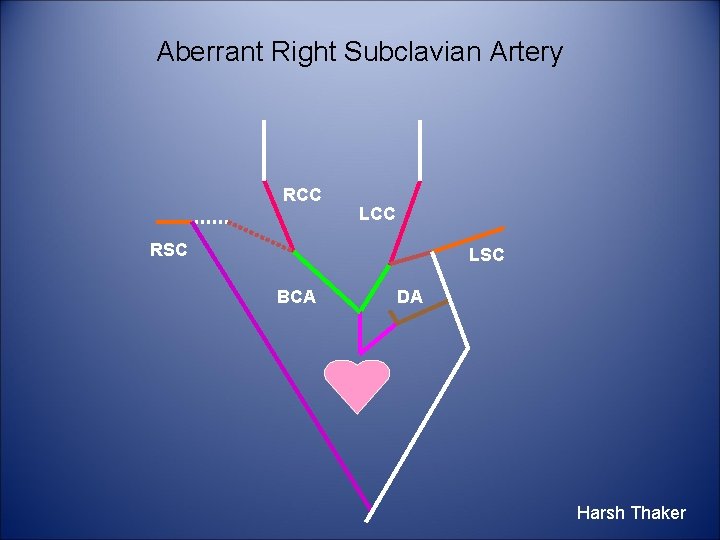 Aberrant Right Subclavian Artery RCC LCC RSC LSC BCA DA Harsh Thaker 