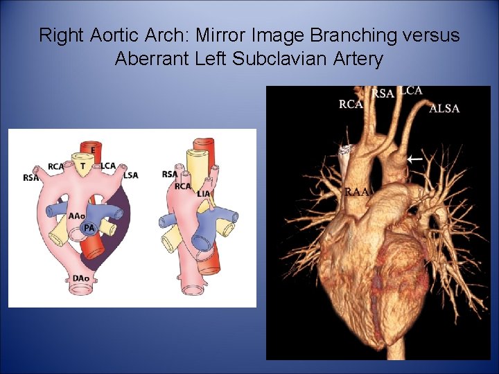Right Aortic Arch: Mirror Image Branching versus Aberrant Left Subclavian Artery 
