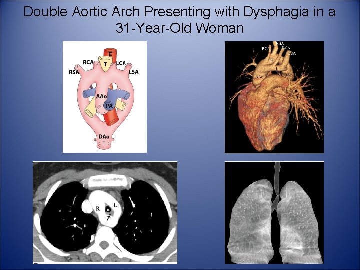 Double Aortic Arch Presenting with Dysphagia in a 31 -Year-Old Woman 