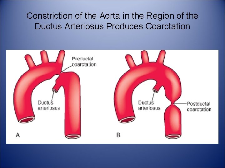Constriction of the Aorta in the Region of the Ductus Arteriosus Produces Coarctation 