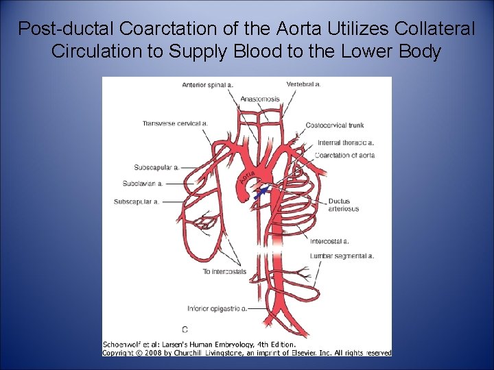Post-ductal Coarctation of the Aorta Utilizes Collateral Circulation to Supply Blood to the Lower