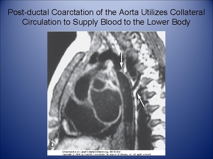 Post-ductal Coarctation of the Aorta Utilizes Collateral Circulation to Supply Blood to the Lower