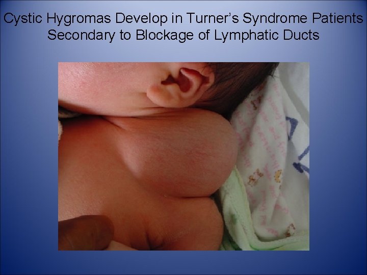 Cystic Hygromas Develop in Turner’s Syndrome Patients Secondary to Blockage of Lymphatic Ducts 