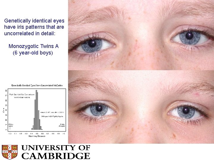Genetically identical eyes have iris patterns that are uncorrelated in detail: Monozygotic Twins A