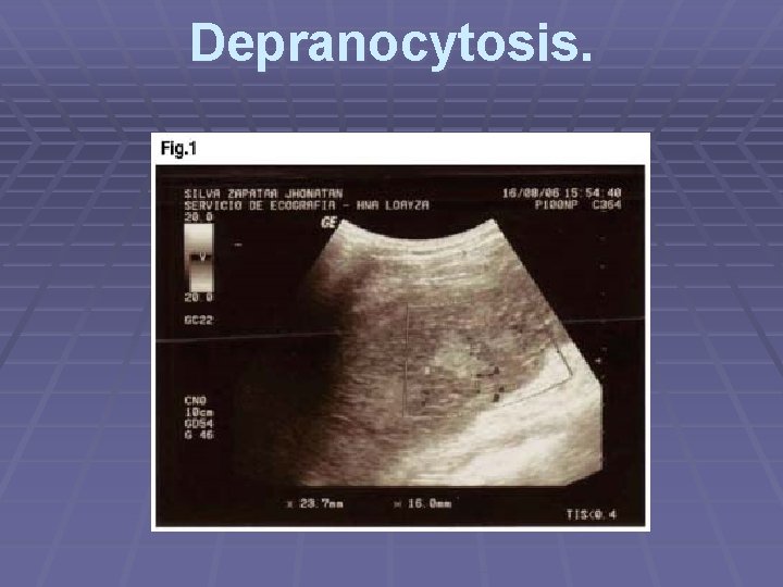 Depranocytosis. 