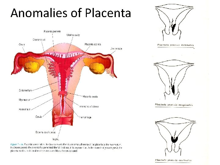 Anomalies of Placenta 22 
