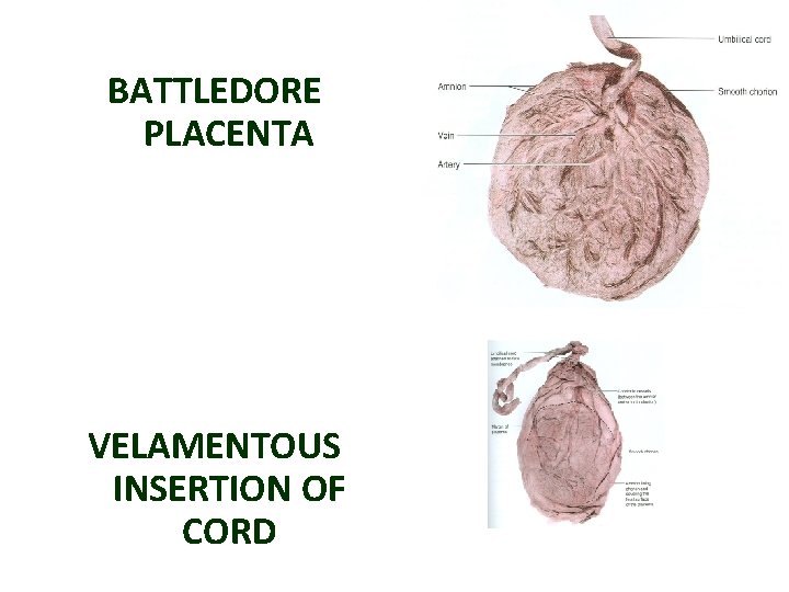 BATTLEDORE PLACENTA VELAMENTOUS INSERTION OF CORD 