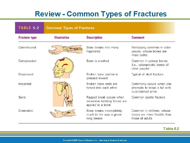 Review - Common Types of Fractures Table 5. 2 Copyright © 2009 Pearson Education,