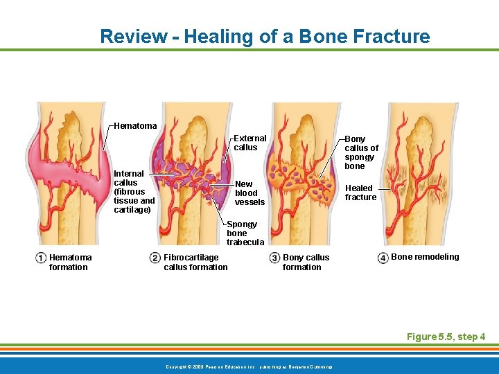 Review - Healing of a Bone Fracture Hematoma Internal callus (fibrous tissue and cartilage)
