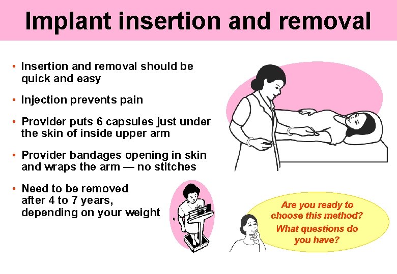 Implant insertion and removal • Insertion and removal should be quick and easy •