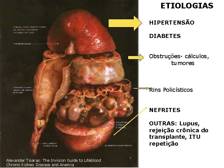ETIOLOGIAS HIPERTENSÃO DIABETES Obstruções- cálculos, tumores Rins Policísticos NEFRITES OUTRAS: Lupus, rejeição crônica do