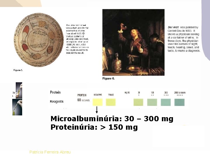 Microalbuminúria: 30 – 300 mg Proteinúria: > 150 mg Patrícia Ferreira Abreu 