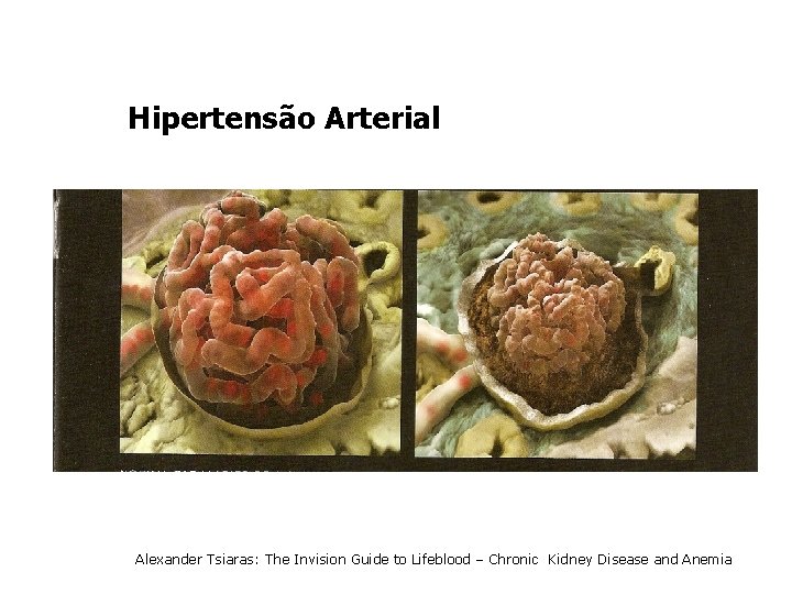 Hipertensão Arterial Alexander Tsiaras: The Invision Guide to Lifeblood – Chronic Kidney Disease and