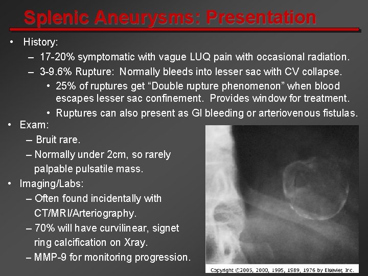 Splenic Aneurysms: Presentation • History: – 17 -20% symptomatic with vague LUQ pain with
