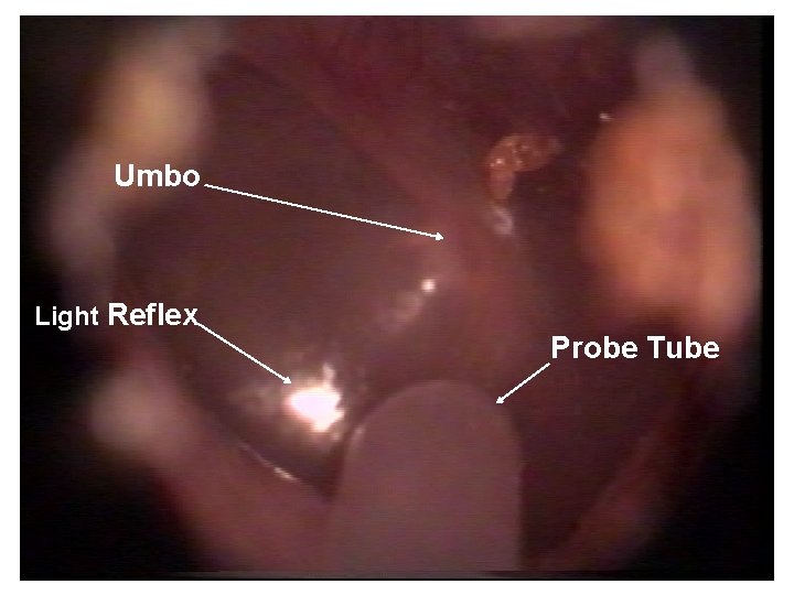 Umbo Light Reflex Probe Tube 